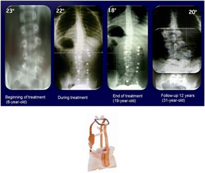 The conservative treatment of congenital scoliosis with hemivertebra: Report of three cases